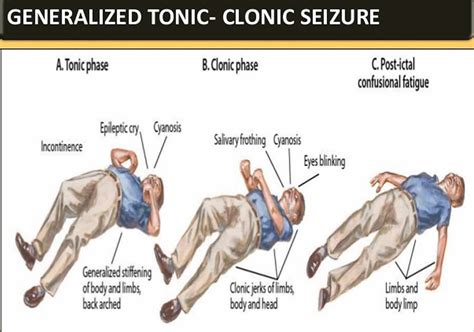 tonic clonic seizure drop test